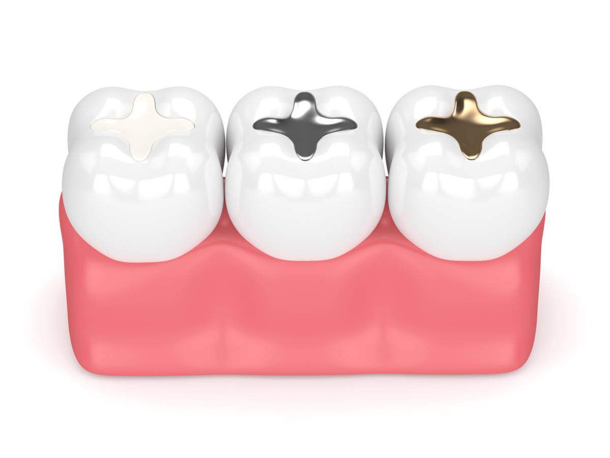 Three types of dental fillings with different lifespans
