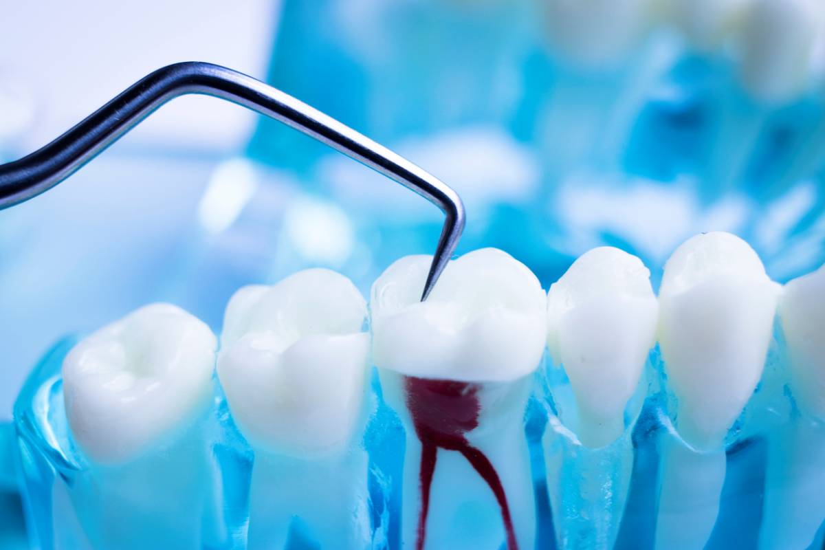 featured image for 8 common myths about root canals