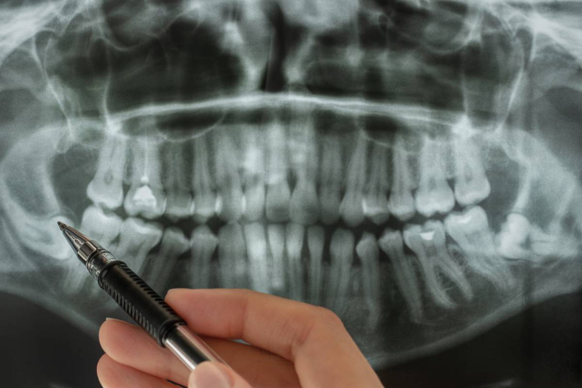 featured image for preparing for wisdom teeth surgery