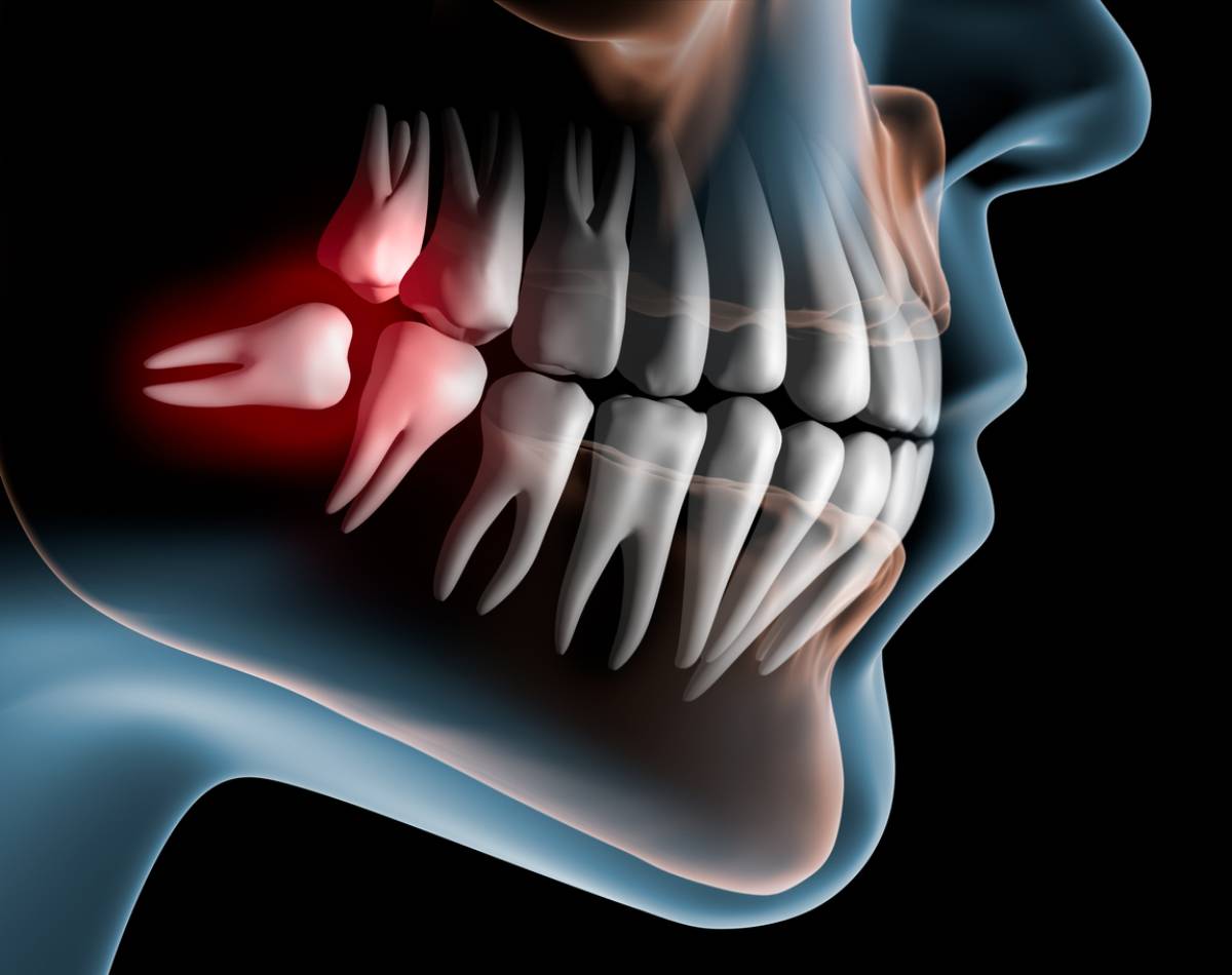 featured image for the top 6 remedies for wisdom teeth pain