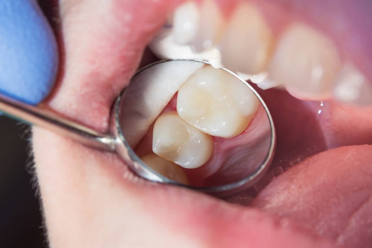 featured image for how often should I replace dental fillings