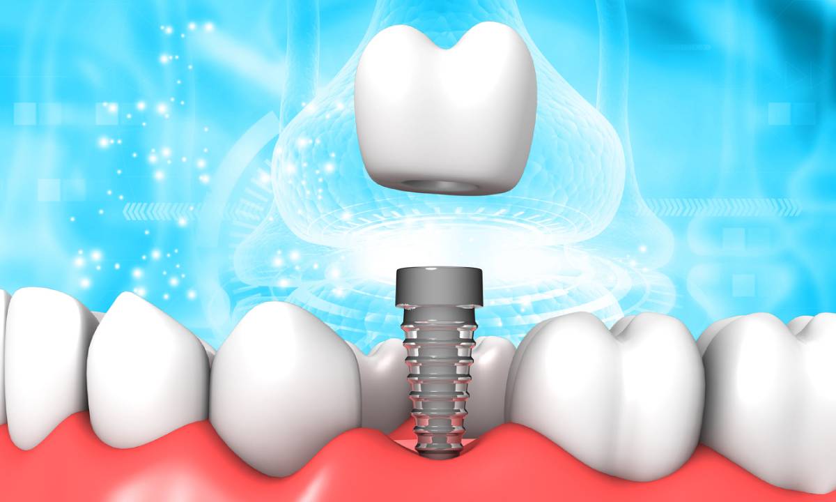 featured for getting dental implants after extraction