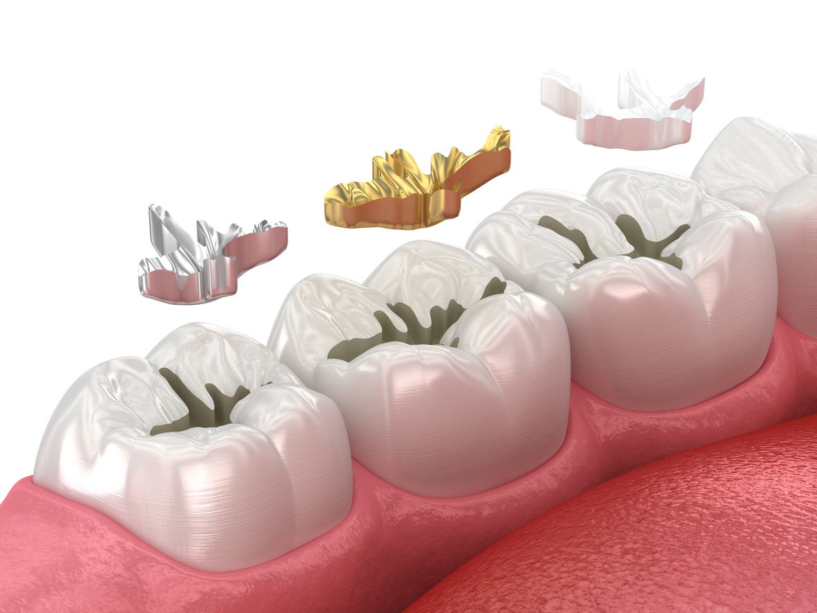 Featured image for 5 Main Types of Dental Fillings