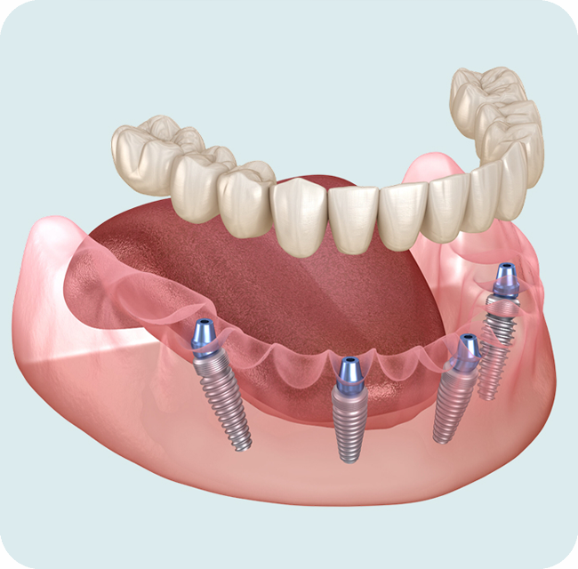 all-on-4 implants image