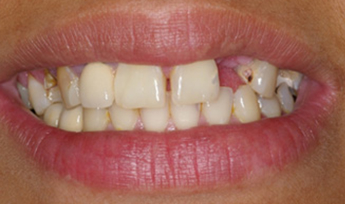 full mouth reconstruction with 9 implants and individual crowns on teeth and implants