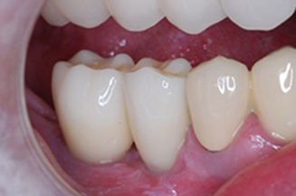 implants and crowns in a single visit
