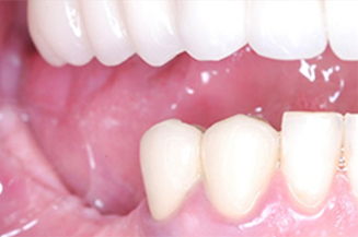 implants and crowns in a single visit