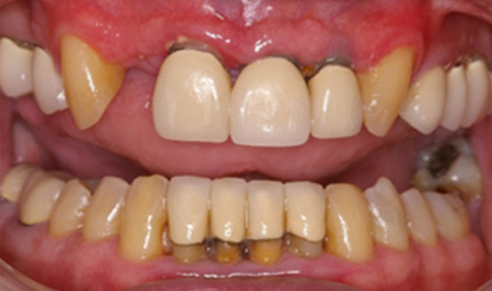 full mouth reconstruction with multiple implants & individual crowns on teeth and implants