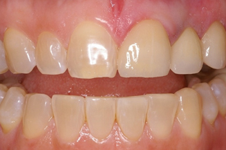 replacing old 3 unit bridge with 1 implant and 3 individual crowns